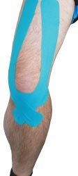 Knee Pain Tape Application