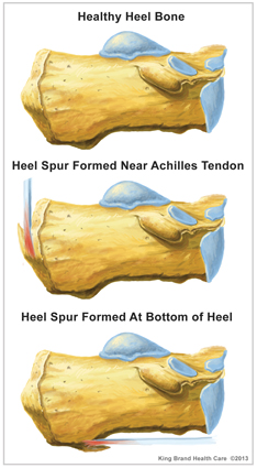 King Brand Heel Spurs Diagram Different Heel Spur Types Illustration Healthy Bottom Achilles Tendon