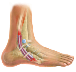 Foot Tendonitis Treatment
