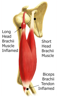 A Drawing of the 2 Types of Bicep Tendonitis - Long Head Brachii Muscle and Biceps Brachii Tendon Inflammation