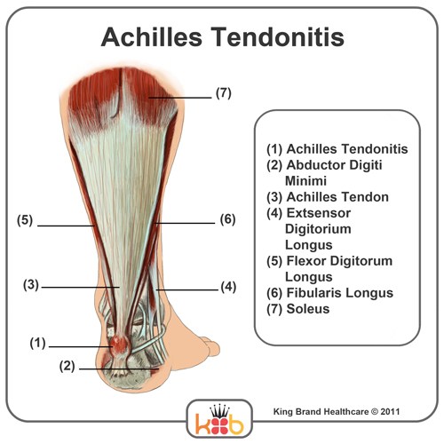 A Detailed Diagram of What Achilles Tendonitis is and Where it Occurs
