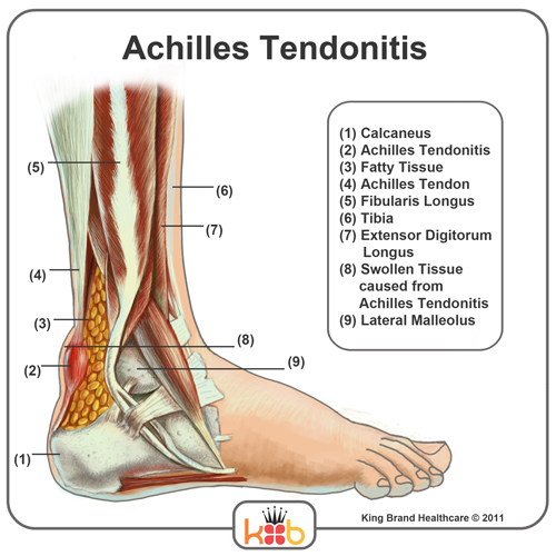 Achilles Tendonitis Injury Image Diagram King Brand Ankle Injury Solutions