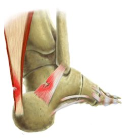 Ankle Ligament Injury Treatment