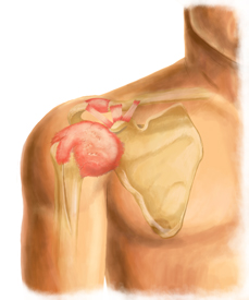 An X-Ray Illustration of an Adhesive Capsulitis Injury