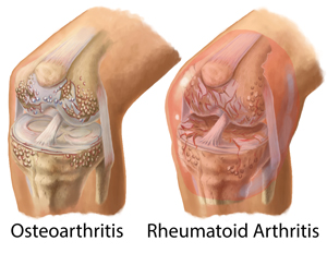 What causes Knee Arthritis