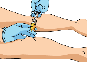 An Illustration of Bakers Cyst Aspiration
