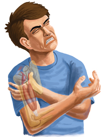 An Illustration of a Person Suffering From a Bicep Tendonitis Injury