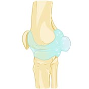 Bakers Cyst Causes