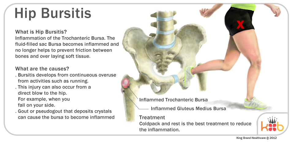 Informational Diagram of Hip Bursitis