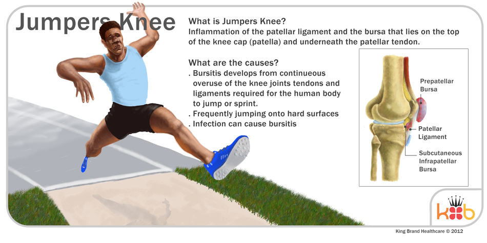 King Brand Jumper's Knee Explaination Information Image Diagram Knee Injury Solutions Ice Packs Wraps