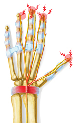 An illustration of the pain and tingling associated with Carpal Tunnel injuries