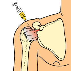 An Illustration of a Person Receiving a Cortisone Shot
