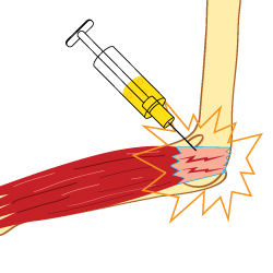 A Drawing of a Cortisone Treatment for a Golfer's Elbow Injury