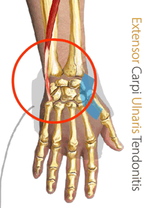 An animation of the King Brand® BFST® Wrist Wrap treating an Extensor Carpi Ulnaris Tendonitis injury
