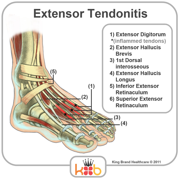 Extensor Tendonitis Injury Image Diagram Labelled King Brand Front and Side Ankle Wrap