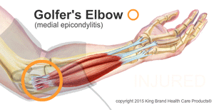 An Animation of King Brand BFST® Technology Treating a Golfer's Elbow Injury