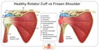 A Small Informational Diagram Comparing Healthy Rotator Cuffs and Frozen Shoulder Injuries