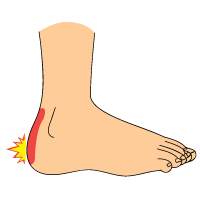 Signs of Heel Bursitis and Plantar Fasciitis