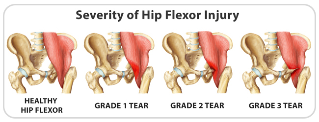 King Brand Severity of Hip Flexor Injuries and Grades of Tears Compared to Healthy Hip Flexor