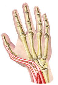 An illustration of a hand suffering from Intersection Syndrome