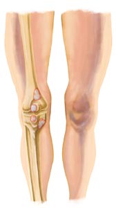 An Internal View of Bursitis in the Knee