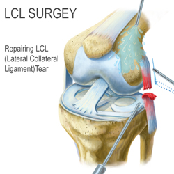 Surgery for Repairing the LCL Illustration