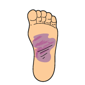 KB Foot Tendonitis Signs and Symptoms