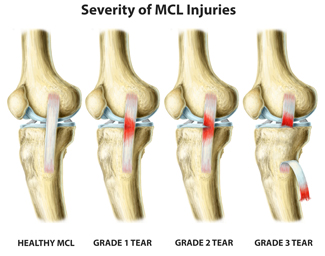 King Brand BFST Coldcure Different Grades of MCL Tears Knee Injury Diagram Image