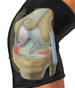What causes Knee Bursitis