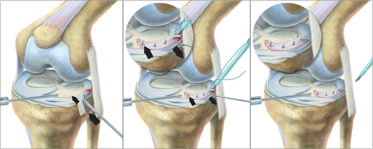 King Brand Meniscus Surgery Knee Diagram Image