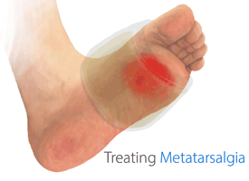 King Brand BFST and ColdCure Can Treat and Hepl Ease the Pain of Metatarsalgia Injuries