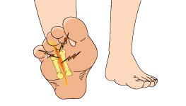 What is Morton Neuroma