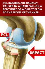 King Brand Knee Injury PCL Diagram Image PCL Causes