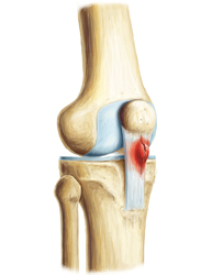 King Brand Knee Pain Relief Patellar Tendonitis Treatment