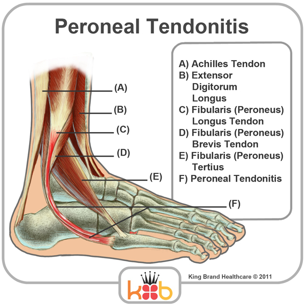 King Brand Ankle Injury Peroneal Tendonitis Diagram Image Labelled