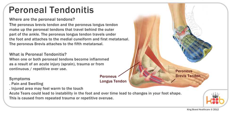 King Brand Ankle Injury Image Diagram Peroneal Tendonitis
