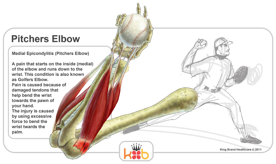 King Brand Pitchers Elbow Information Diagram Facts Treatment