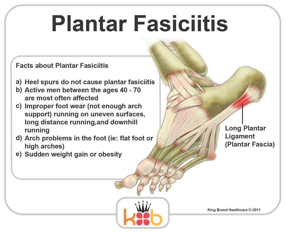 Plantar Fasciitis Injury Facts and Symptoms Illustration Treat Your Soft Tissue Injuries with King Brand