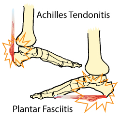 Plantar Fasciitis Vs Achilles Tendonitis Anatomy Diagram