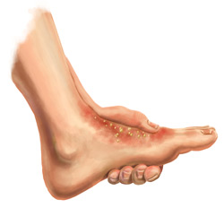 Foot Redness Rash Side Effect