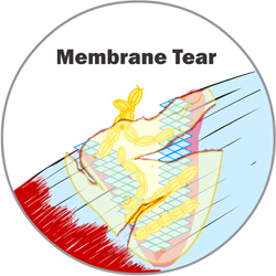 Membrane Tear