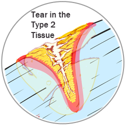 Type 2 Tissue Tear