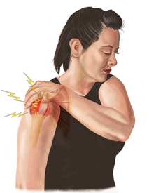 An Illustration of a Person Suffering From a Rotator Cuff Injury