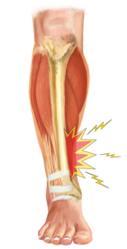 An Internal View of a Shin Splint Injury