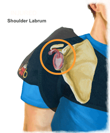 An Animation of the King Brand Side Shoulder BFST Wrap Treating a Shoulder Labrum Injury Overlaid on a Person