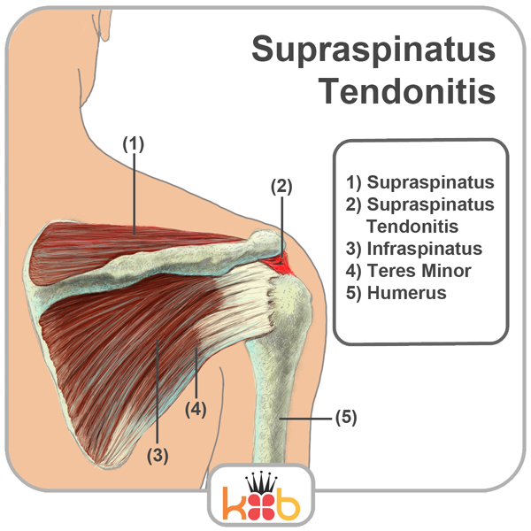 King Brand Shoulder Injury Treatment Supraspinatus Tendonitis Diagram Illustration Back View