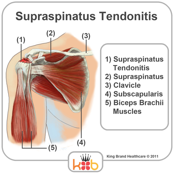King Brand Shoulder Injury Treatment Supraspinatus Tendonitis Diagram Illustration Front View Bones Muscles