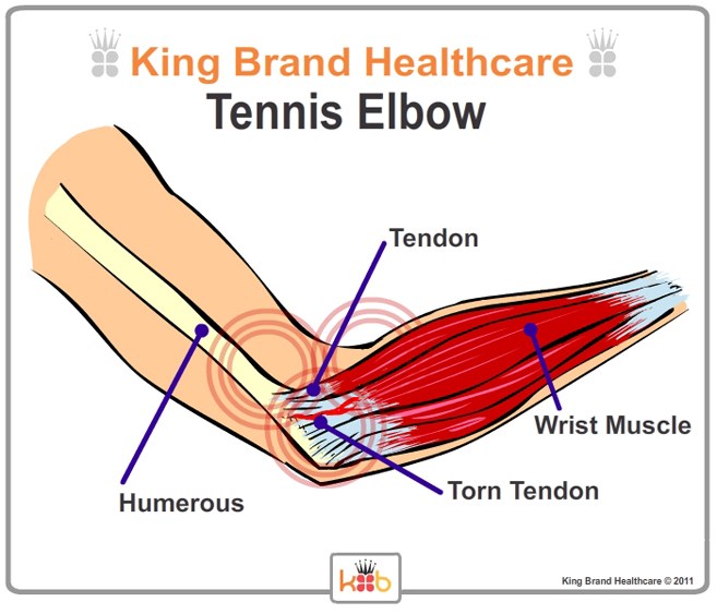 Tennis Elbow Outside View Lablled Diagram King Brand Image