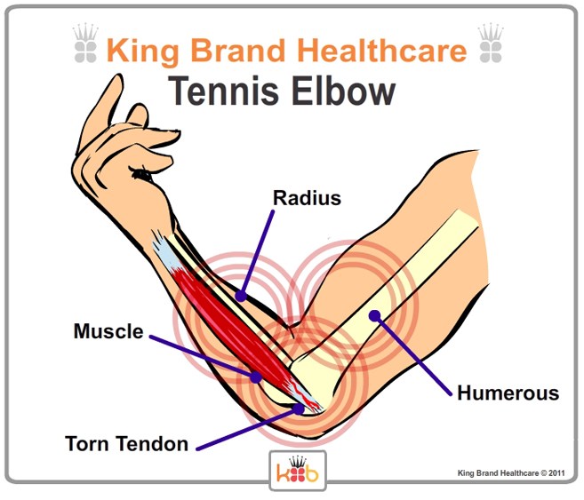 Tennis Elbow Inside View Lablled Diagram King Brand Image