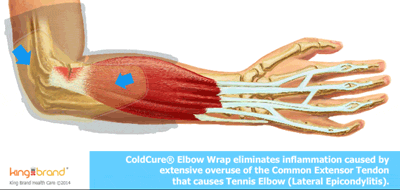 Animation of a King Brand ColdCure® Wrap Working to Reduce Inflammation and Swelling